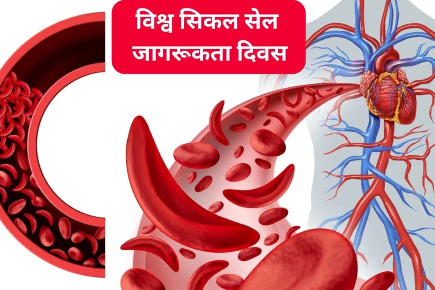 रक्त की बूँद में छिपा संघर्ष: विश्व सिकल सेल जागरूकता दिवस