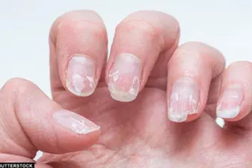 अगर आपके नाखून भी बार-बार टूट रहे हैं तो ये कोई सामान्य समस्या नहीं 