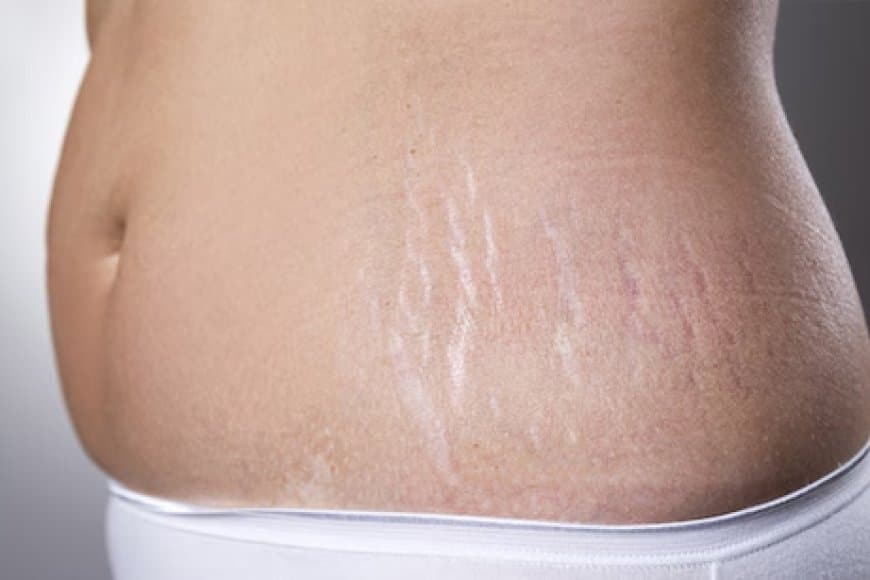 गर्भावस्था के बाद स्ट्रेच मार्क्स हटाने अपनाएं ये नुस्खे, कुछ दिनों में ही दिखने लगेगा फायदा 