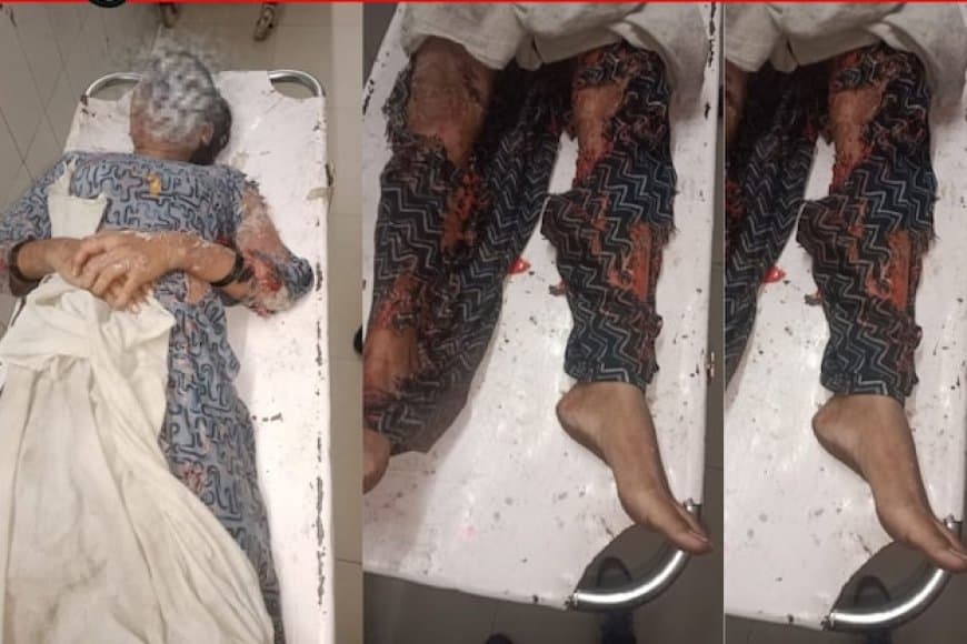 ग्वालियर... निकाह से इंकार पर भड़के जेठ ने भाई की पत्नी पर फेंका तेजाब