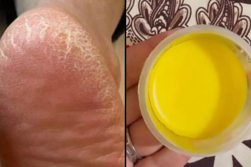  फ़टी एड़ियों से तुरंत मिलेगी राहत, घर पर बनाएं ये फुट क्रीम  