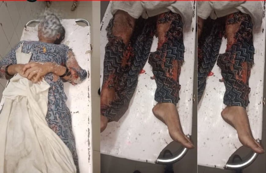 ग्वालियर... निकाह से इंकार पर भड़के जेठ ने भाई की पत्नी पर फेंका तेजाब