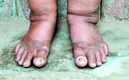 सतना–मैहर में फाइलेरिया उन्मूलन का बड़ा अभियान: 290 स्कूलों के 4105 बच्चों की होगी जांच, 18 सर्वे टीमों के साथ ट्रांसमिशन असेसमेंट सर्वे-3 का फाइनल राउंड शुरू