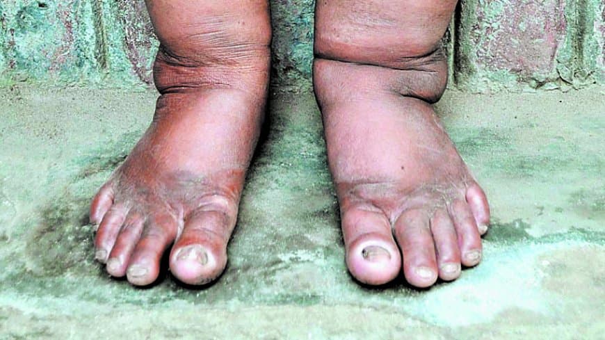 सतना–मैहर में फाइलेरिया उन्मूलन का बड़ा अभियान: 290 स्कूलों के 4105 बच्चों की होगी जांच, 18 सर्वे टीमों के साथ ट्रांसमिशन असेसमेंट सर्वे-3 का फाइनल राउंड शुरू