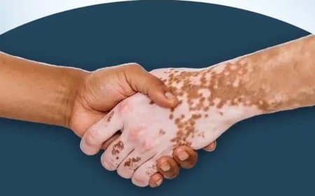 कुष्ठ रोग दिवस आज: इलाज आसान, असली चुनौती कलंक मिटाना 