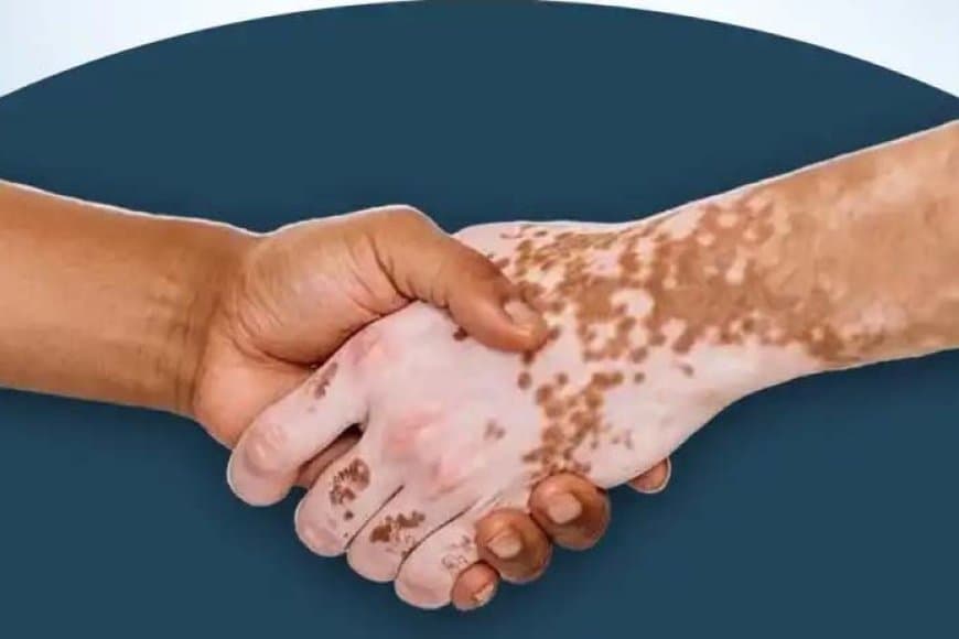 कुष्ठ रोग दिवस आज: इलाज आसान, असली चुनौती कलंक मिटाना 