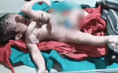 MP छतरपुर में जन्मा 4 हाथ-पैर वाला अद्भुत बच्चा, डॉक्टर बोले- एक-दो लाख में होता है ऐसा एक केस