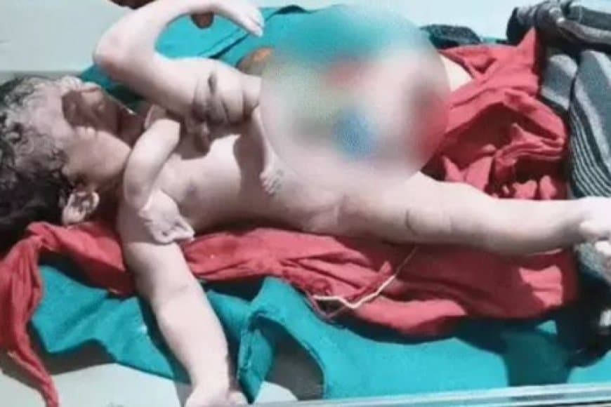 MP छतरपुर में जन्मा 4 हाथ-पैर वाला अद्भुत बच्चा, डॉक्टर बोले- एक-दो लाख में होता है ऐसा एक केस