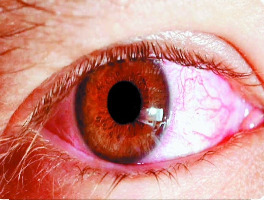 सीधी जिले में आंखों के संक्रमण की महामारी! स्कूलों तक फैला कंजेक्टिवाइटिस, बच्चे चश्मा पहनने और घर लौटने को मजबूर सीधी जिले में आंखों के संक्रमण की महामारी! स्कूलों तक फैला कंजेक्टिवाइटिस, बच्चे चश्मा पहनने और घर लौटने को मजबूर