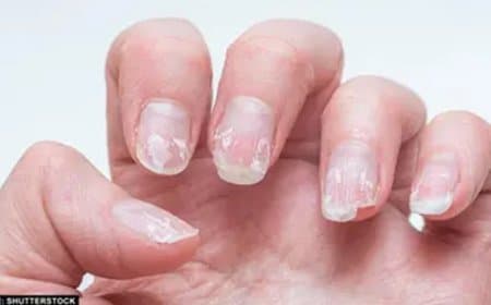 अगर आपके नाखून भी बार-बार टूट रहे हैं तो ये कोई सामान्य समस्या नहीं