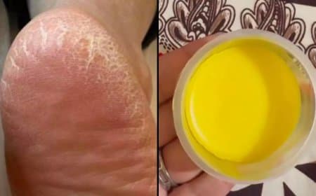 फ़टी एड़ियों से तुरंत मिलेगी राहत, घर पर बनाएं ये फुट क्रीम