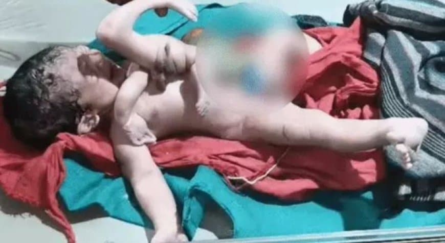 MP छतरपुर में जन्मा 4 हाथ-पैर वाला अद्भुत बच्चा, डॉक्टर बोले- एक-दो लाख में होता है ऐसा एक केस MP छतरपुर में जन्मा 4 हाथ-पैर वाला अद्भुत बच्चा, डॉक्टर बोले- एक-दो लाख में होता है ऐसा एक केस